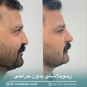 عکس قبل و بعد فیلر بینی شیراز