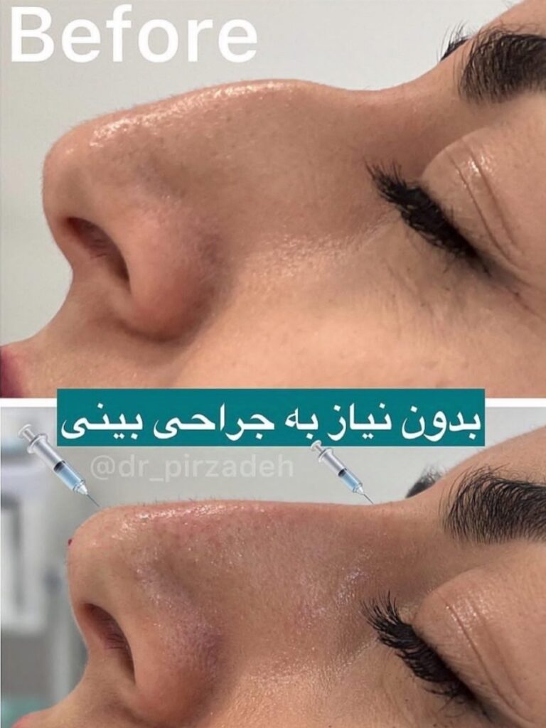 نمونه کار تزریق فیلر بینی اصفهان دکتر پیرزاده